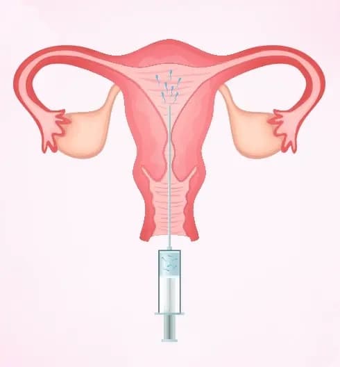 IUI